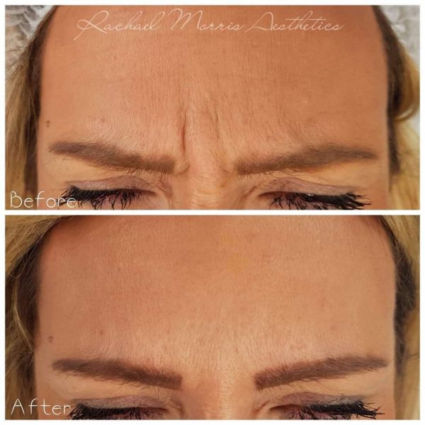 northampton-botox-anti-wrinkle-injections-one1