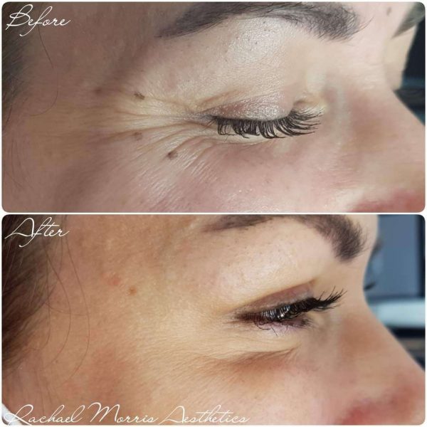 northampton-botox-anti-wrinkle-injections-two1