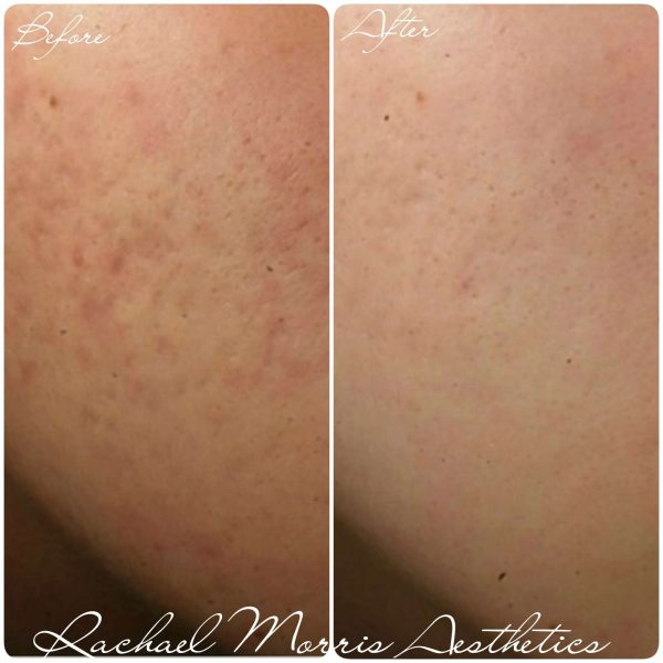 northampton-microneedling-treatment-two