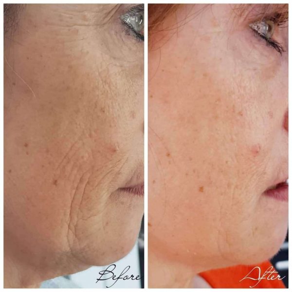 northampton-profhilo-nahyco-technology-four