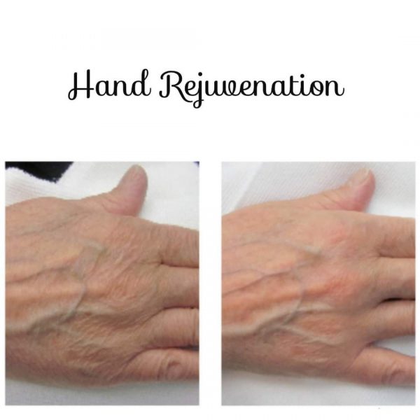 northampton-profhilo-nahyco-technology-one