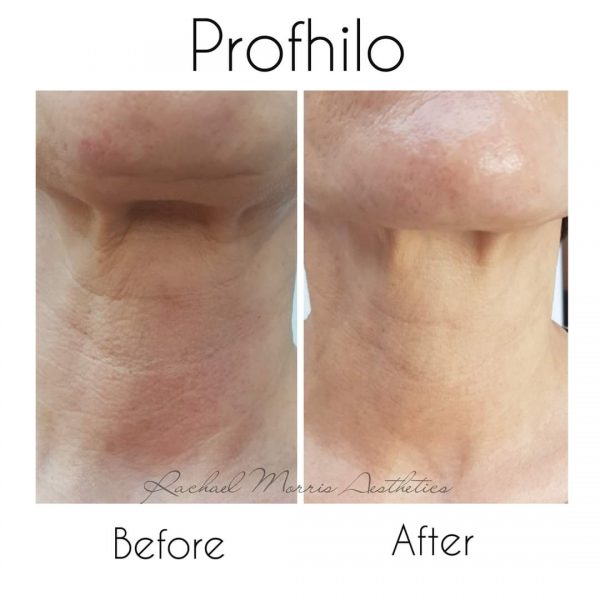 northampton-profhilo-nahyco-technology-two