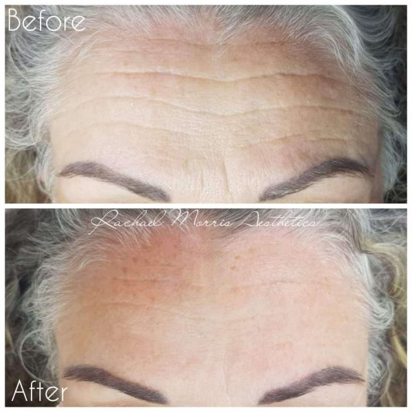 northampton-skin-boosters-one