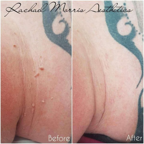 northampton-skin-tag-and-mole-removal-one
